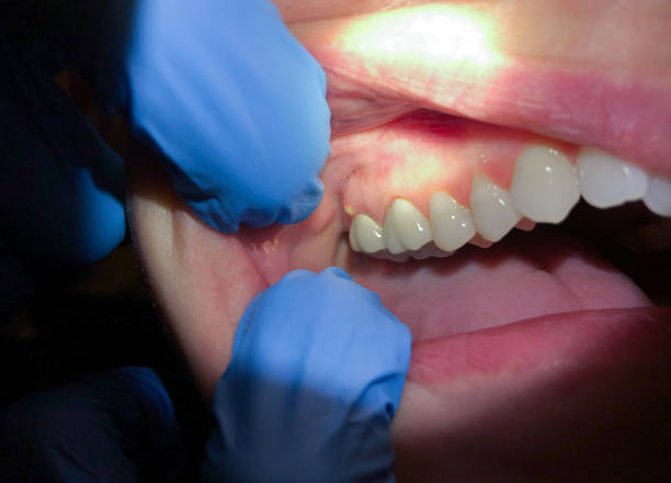Best Broken or Chipped Tooth Repair in Lexington, MN
